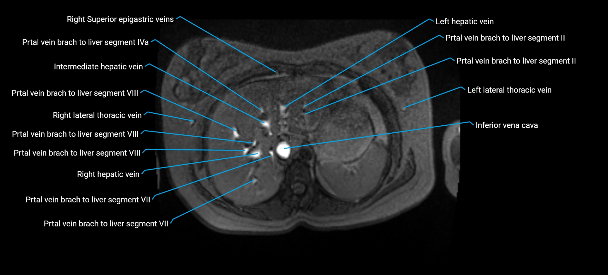 MRV abdomen pelvis & lower limb axial cross sectional anatomy labelled MRI image 30 (1).webp